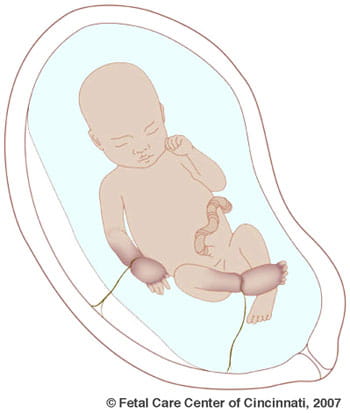 Amniotic Band Syndrome Illustration